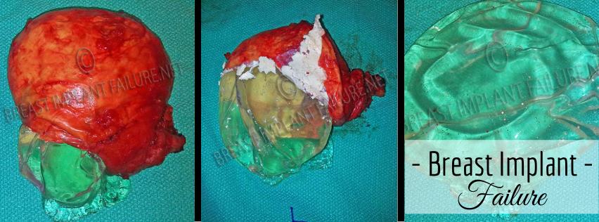 breast-implant-failure