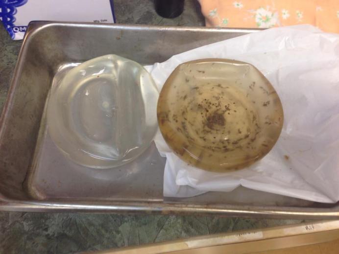 breast implants for blog 4