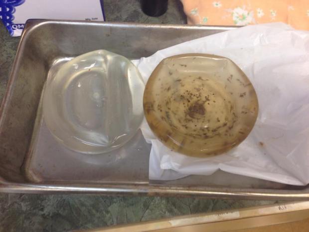 breast implants for blog 4