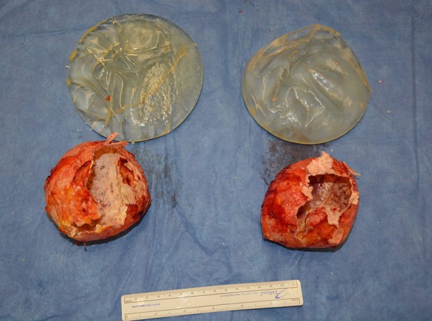 breast implants for blog 5