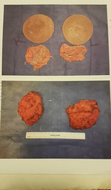 breast implants for blog 6