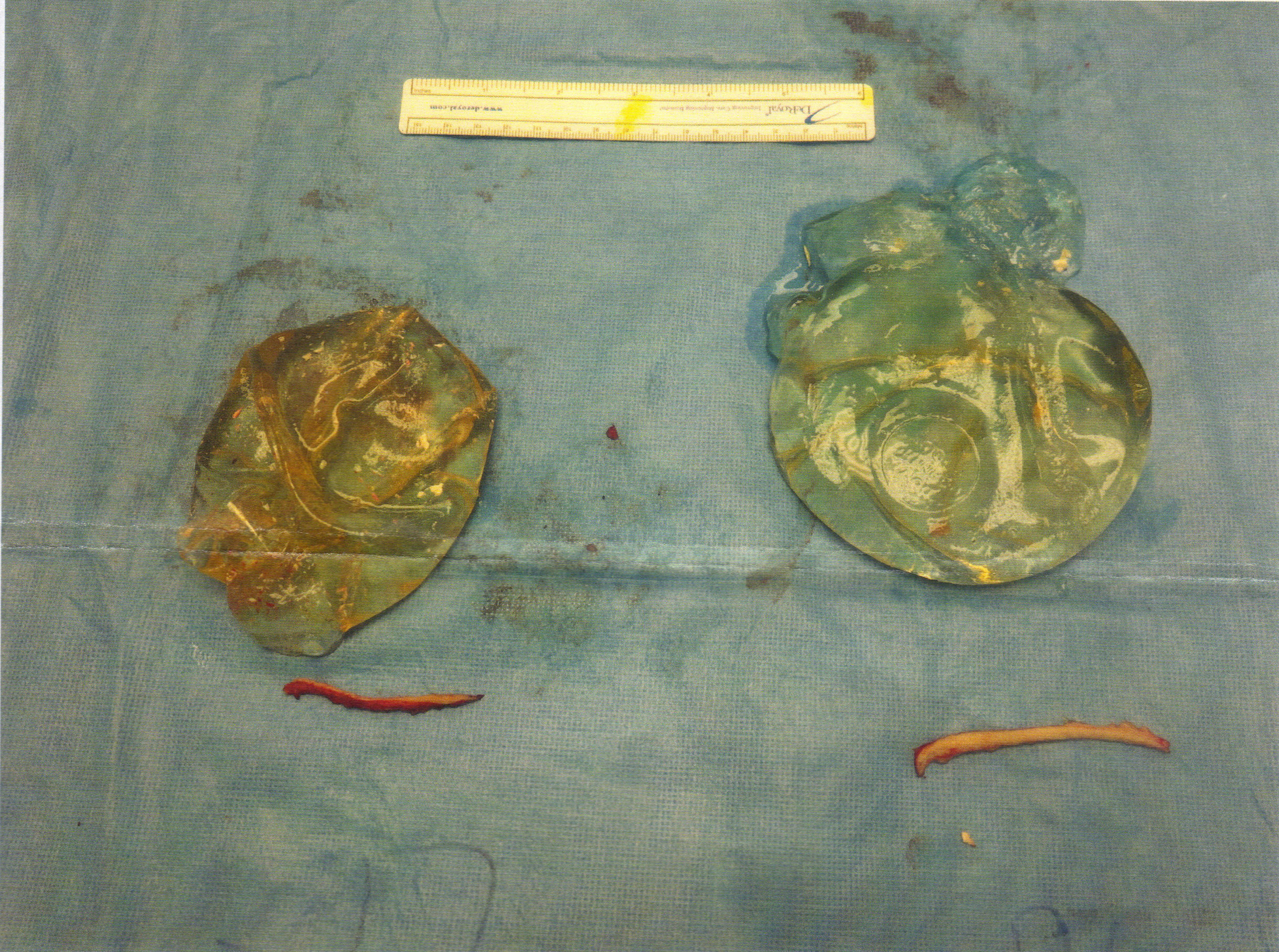 Darlene Lucado Dow Corning implanted 1981 Explanted 2014