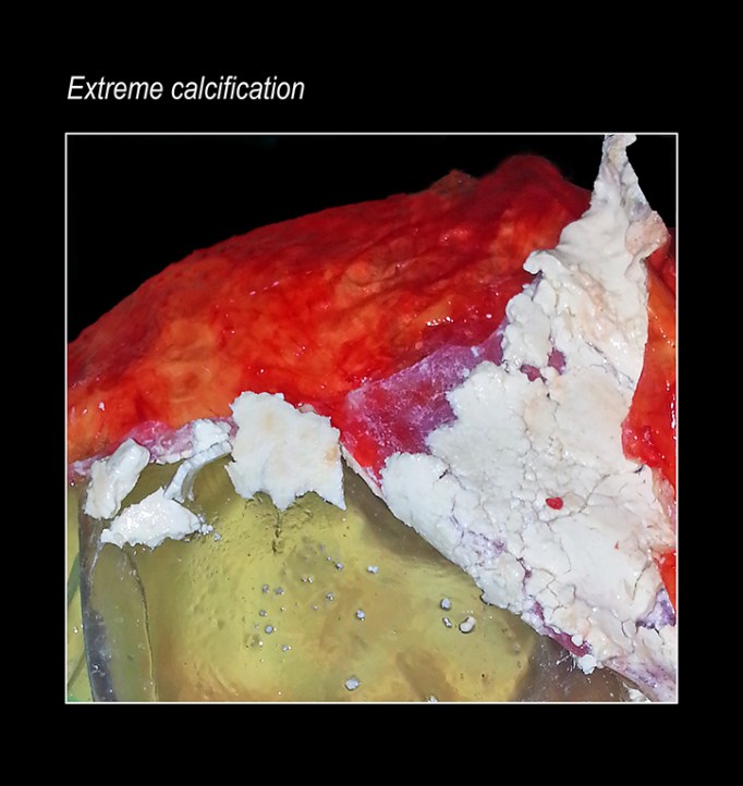 extreme calcification resized