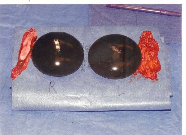 moldy implants Sandy Worth posted Explant Info