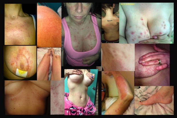 rashes 16 X 24_resize