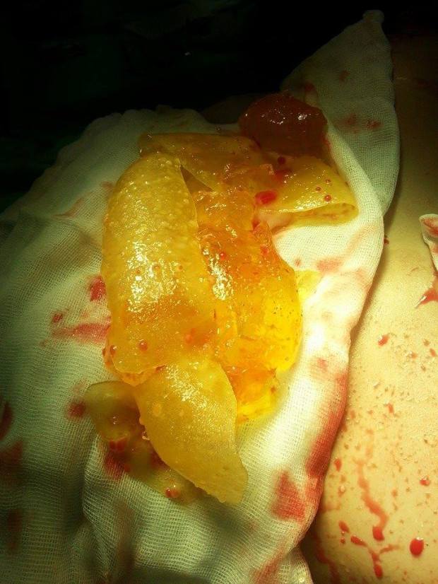 Ruptured PIP Dr Jaume Serra Janer permission granted