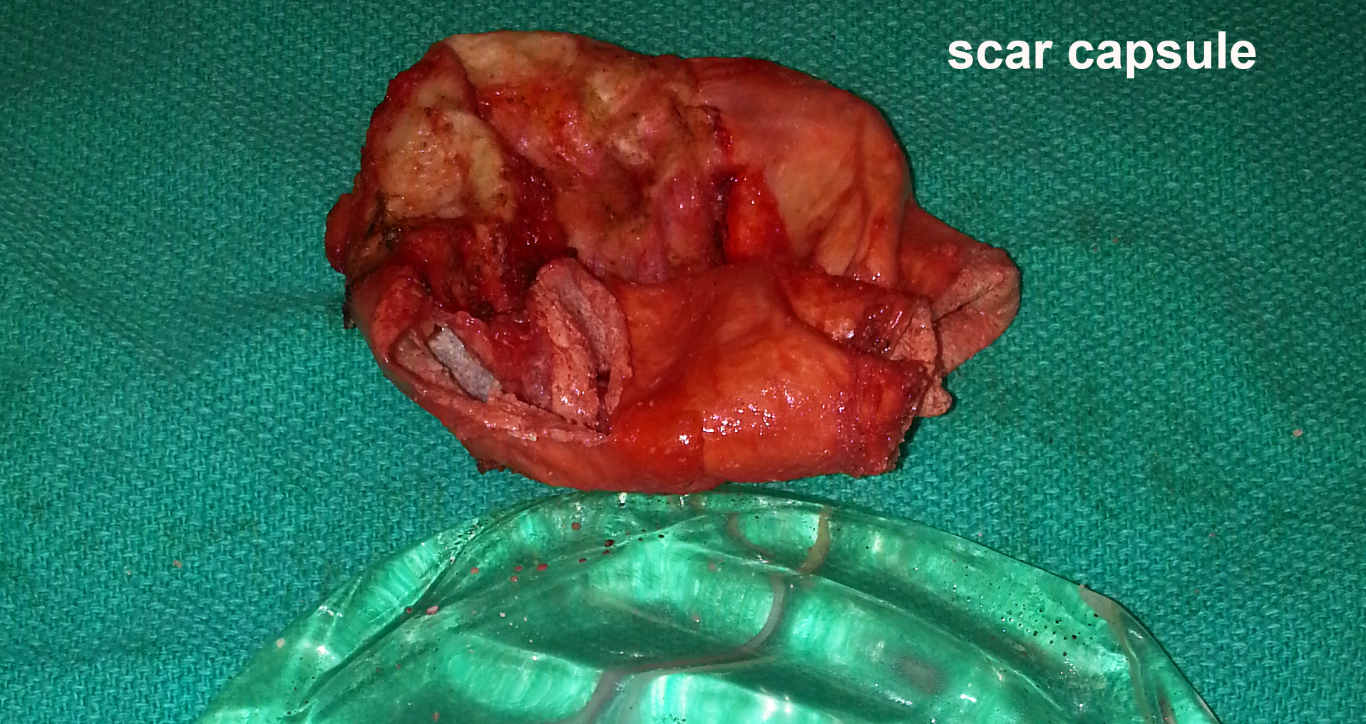 Destructive Changes | Breast Implant Failure & Illness