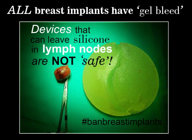 silicone-in-lymph-node-new-text-rs