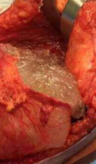 ruptured cohesive gel and scar capsule 2