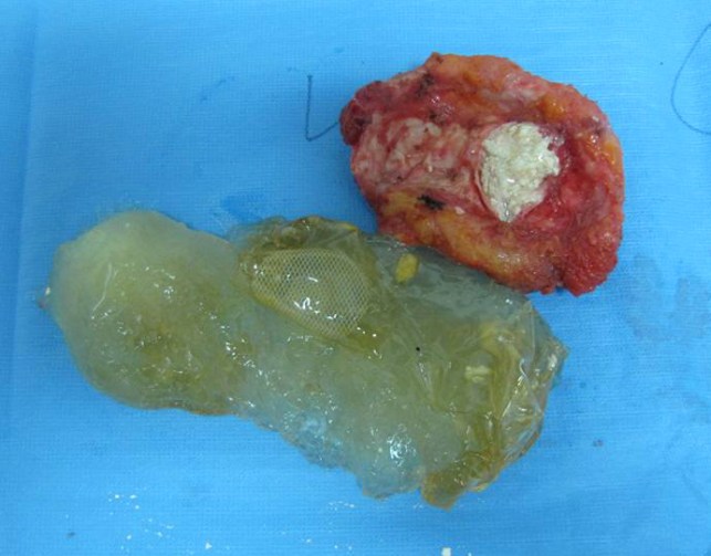 ruptured implant and scar capsule blog