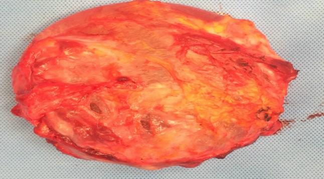 scar capsule inflammation b