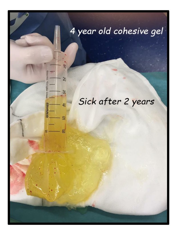 sick after 2 years cohesive gel 4 years old background stroke crop flat flat