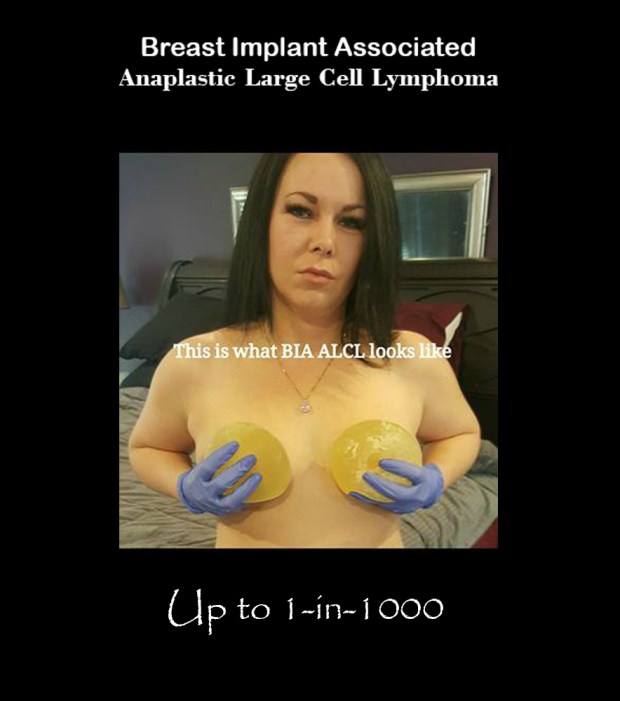 what bia-alcl looks like background crop 2 flat