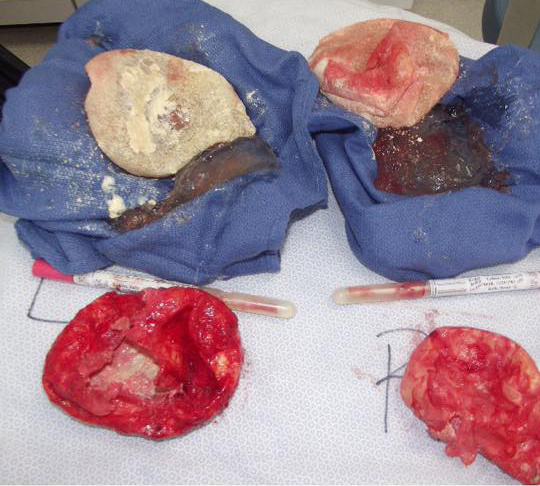 25 year old silicone implants