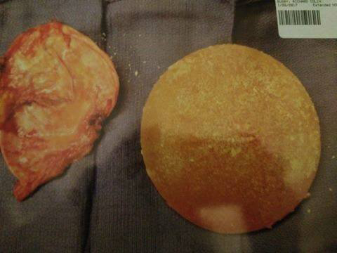 25 yr old McGhan textured