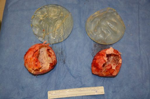 29 year old silicone uwp