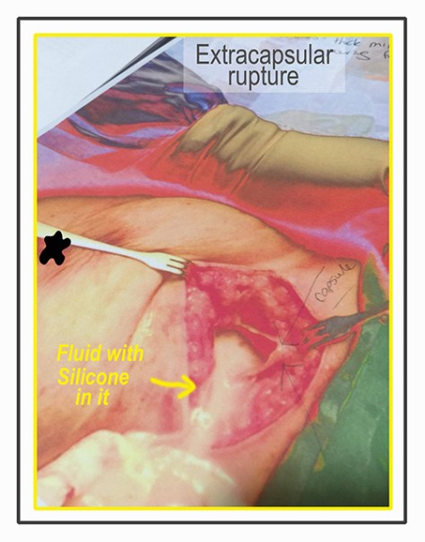 PIP FLUID with SILICONE RS