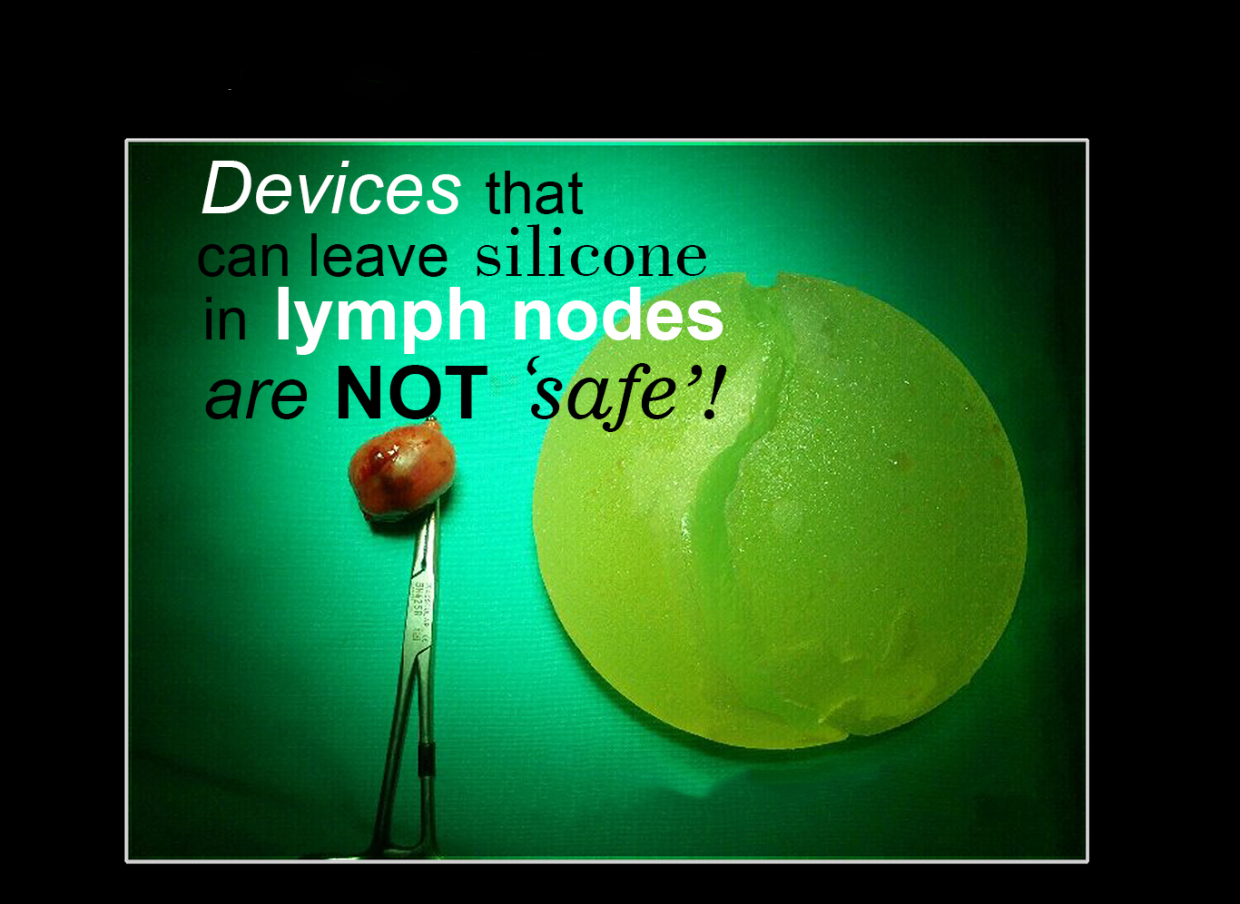 Silicone in lymph nodes revisited