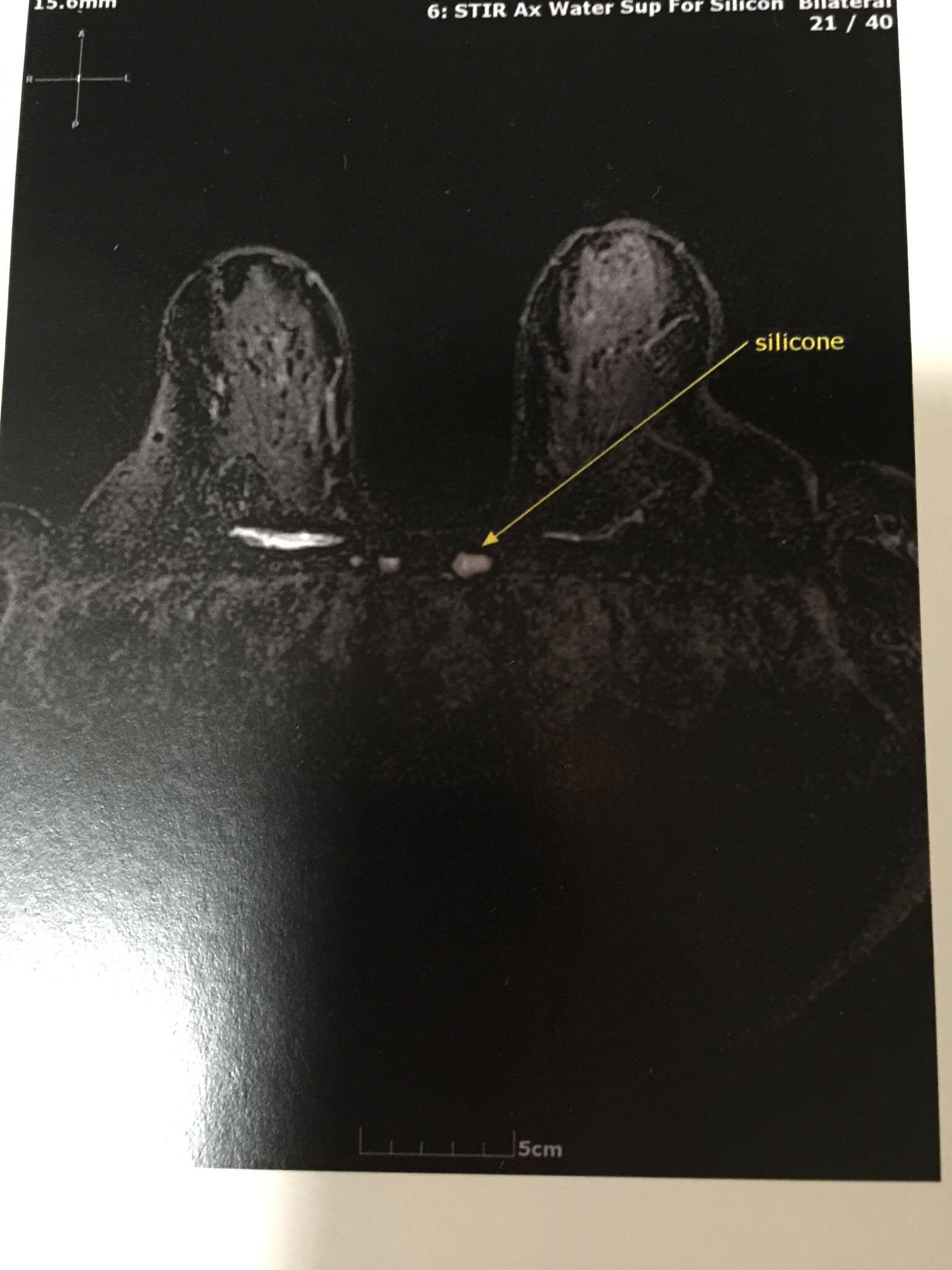 Silicone over heart 2.jpg