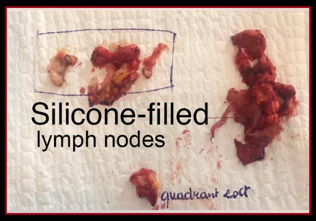 silicone filled lymph nodes 2 rs