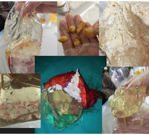 Explant Collage for Blog