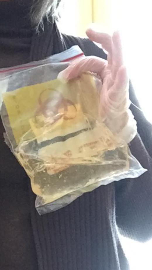 what remained in my left implant