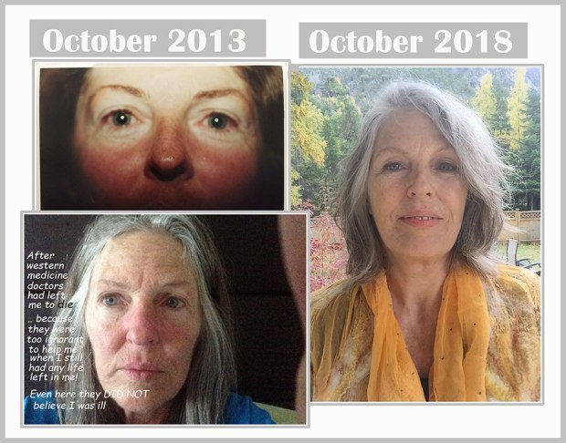 5th Explant Anniversary 2018 healed RS